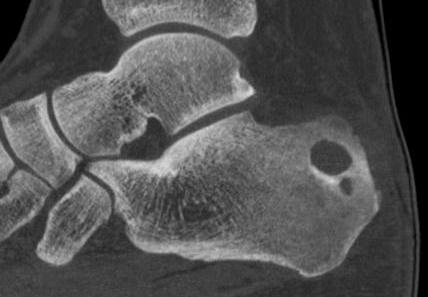 Calcaneal Bony Lesion CT